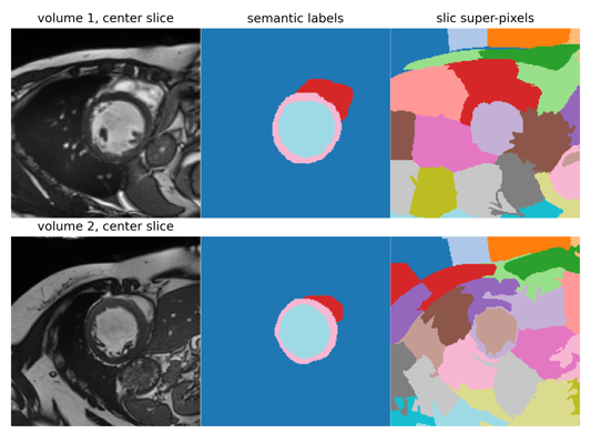 Local contrastive loss with pseudo-label based self-training for semi ...